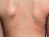 Kako nastaju alergije?