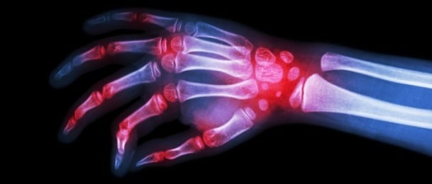 Najbolji saveznici u borbi protiv artritisa