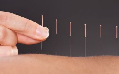 Akupunktura – drevna kineska medicina